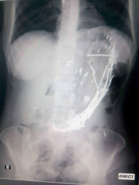  Doctors Remove Nails, Pens, Spoon From Stomach Of Woman With Medical Conditon Jolk4