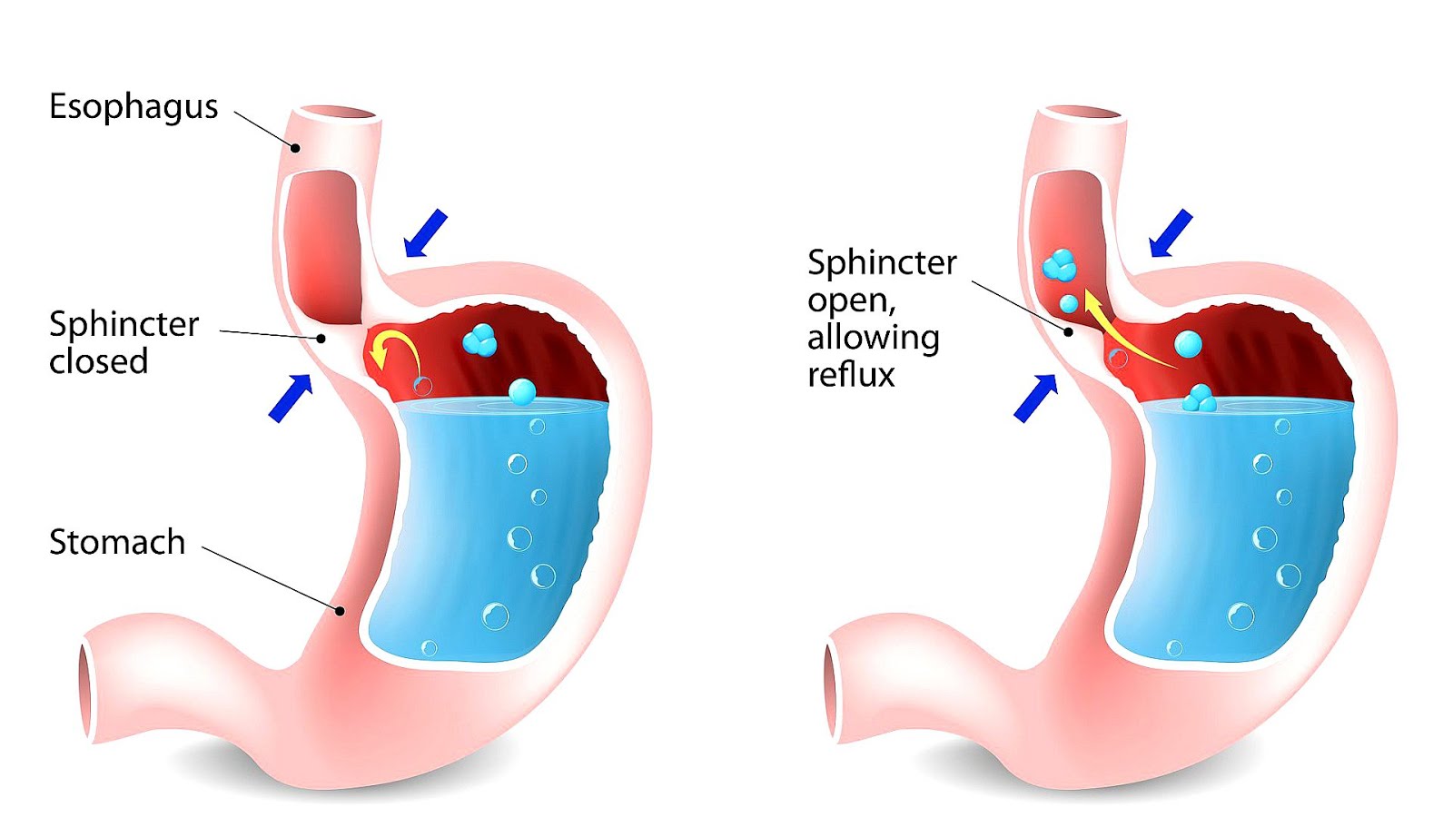 How To Quickly Get Rid Of Heartburn Hear Choices how-to-quickly-get-rid-of-heartburn-hear-choices