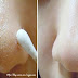 How to Remove Blackheads From Nose & Face – Indian Secret