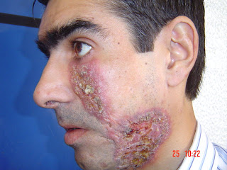 How To Remove Hidradenitis Suppurativa With Natural Treatment How