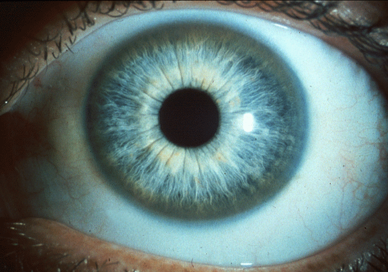 Dental Mnemonics Wilson's Diseases