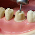 Làm cầu răng sứ có tốt không khi bị mất 2 răng?