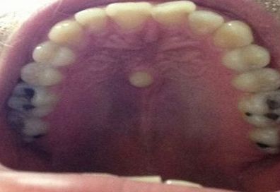 Kenapa Langit Langit Mulut Sakit - Homecare24