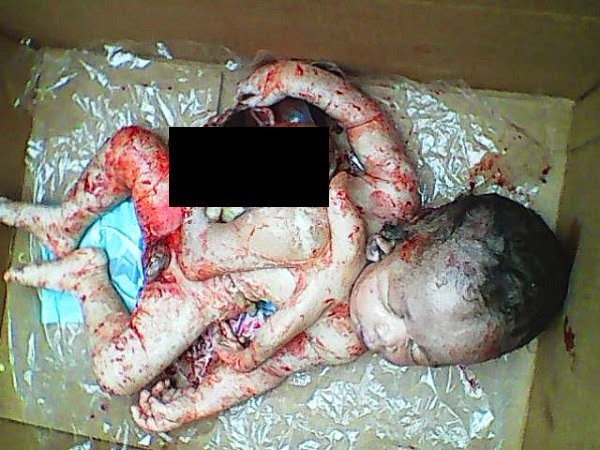 PHOTO: Woman Gives Birth To Baby With 3 Legs, 4 Arms And 3 Ears In Rivers State 2