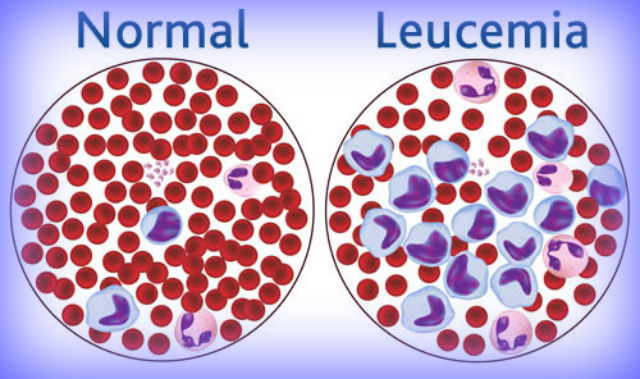 leucemia infantil sinais e sintomas de diabetes