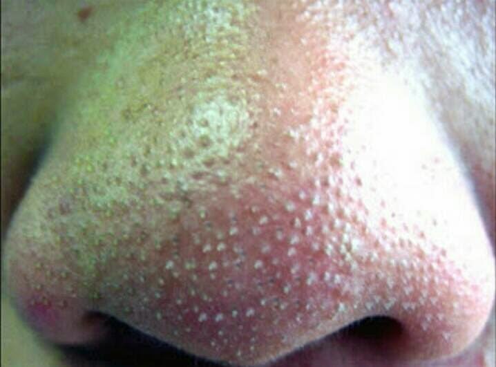 TIPS Dan Petua Mudah Untuk Hilangkan Blackhead & Whitehead Di Wajah