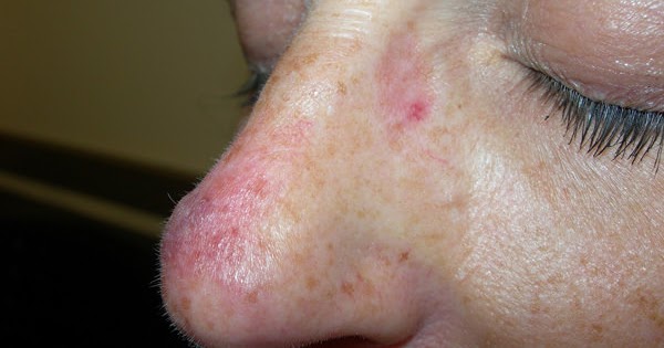 Cap Kraken: Enlarged Liver – Natural Cure for Enlarged Liver