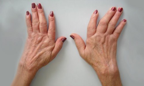tretiranje artritisa u slovačkoj