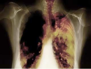 alternatif kanker Paru stadium 1, obat kanker paru, pengobatan kanker paru