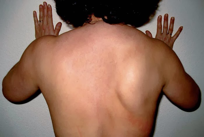 elneuroblogSg Lo que he aprendido de… ESCÁPULA ALADA elneuroblogSg Lo que he aprendido de… ESCÁPULA ALADA