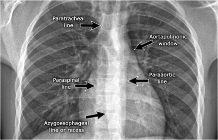 Chest Medicine Made Easy-Dr Deepu: BASICS OF CHEST X RAY-PART 5, THE ...