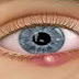 Κριθαράκι στο μάτι: Αίτια, πρόληψη & αντιμετώπιση [video]