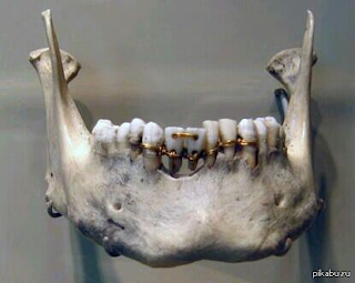 Zákrok jež zachránil zuby. Jednalo se zejména o estetický zákrok. Publikováno z http://dental-polishers.com/679/dentistry-in-ancient-egypt