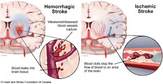 obat herbal stroke yang ampuh obat herbal stroke yang ampuh, obat herbal stroke, obat stroke yang ampuh