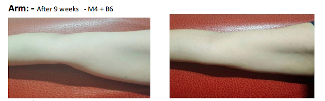HIFU Before & After - Upper Arms