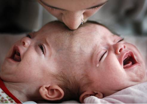 Most Amazing: Conjoined twins Amazing Pictures