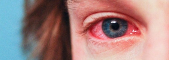 Silnie zaczerwienione oko & krople Starazolin na przekrwienie oczu