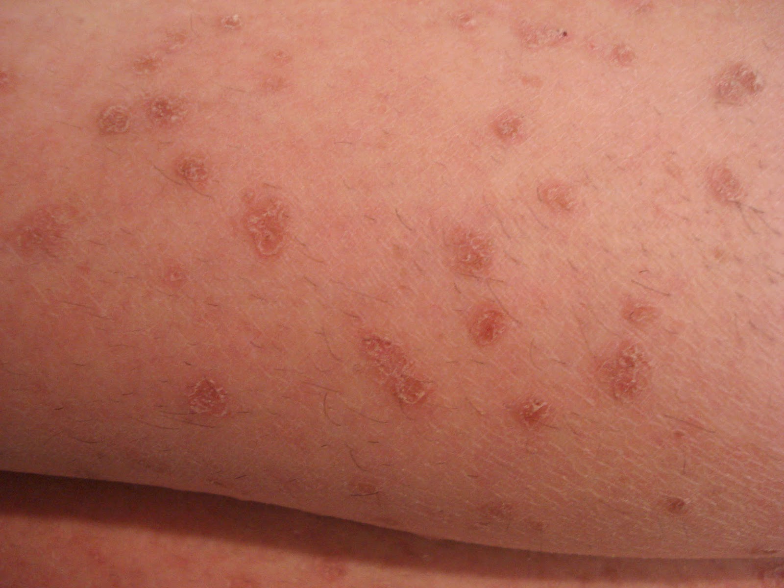 VIRTUAL GRAND ROUNDS IN DERMATOLOGY 2.0: Primary Biliary Cholangitis
