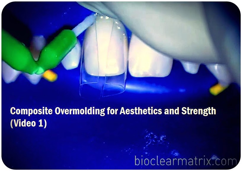 OPERATIVE DENTISTRY Composite Overmolding for Aesthetics and Strength