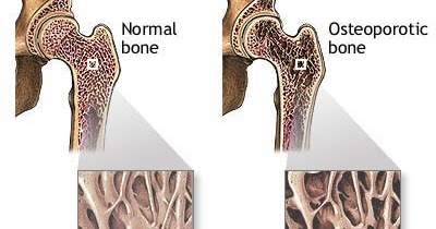 Penyakit Osteoporosis - DiditWidiarto.Com