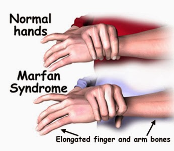 Marfan Syndrome Hands