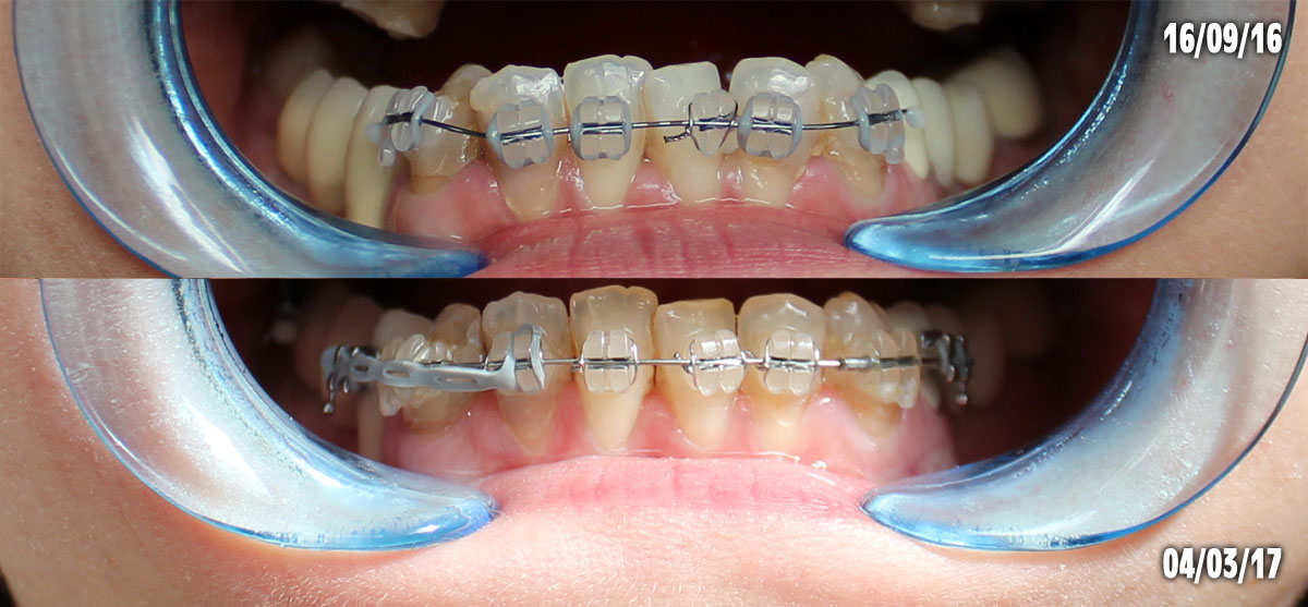 SRAM Unisexe - 2039100152 Ressort D'écartement Multicolore 17