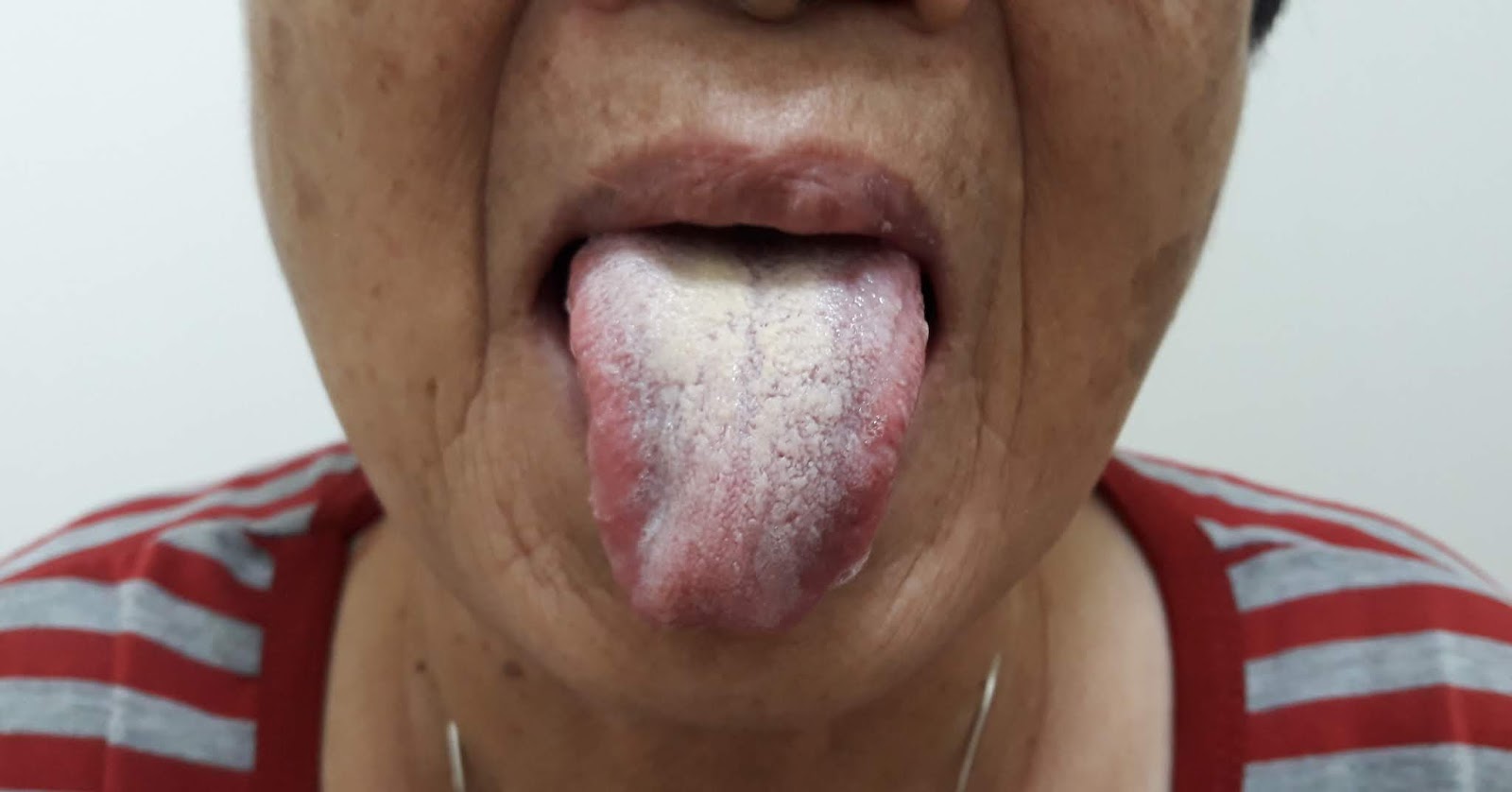 儿童舌苔图片对应症状-图库-五毛网