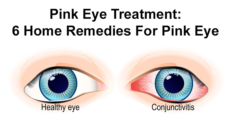 Pankaj Kashyap Pink Eye Treatment 6 Simple Home Remedies For Pink Eye Pankaj Kashyap Pink Eye Treatment 6 Simple Home Remedies For Pink Eye