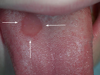 Studio Dentistico Balestro: Celiachia e manifestazioni orali