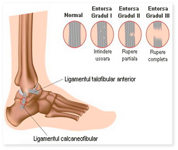 Boli ale articulațiilor gleznei picioarelor