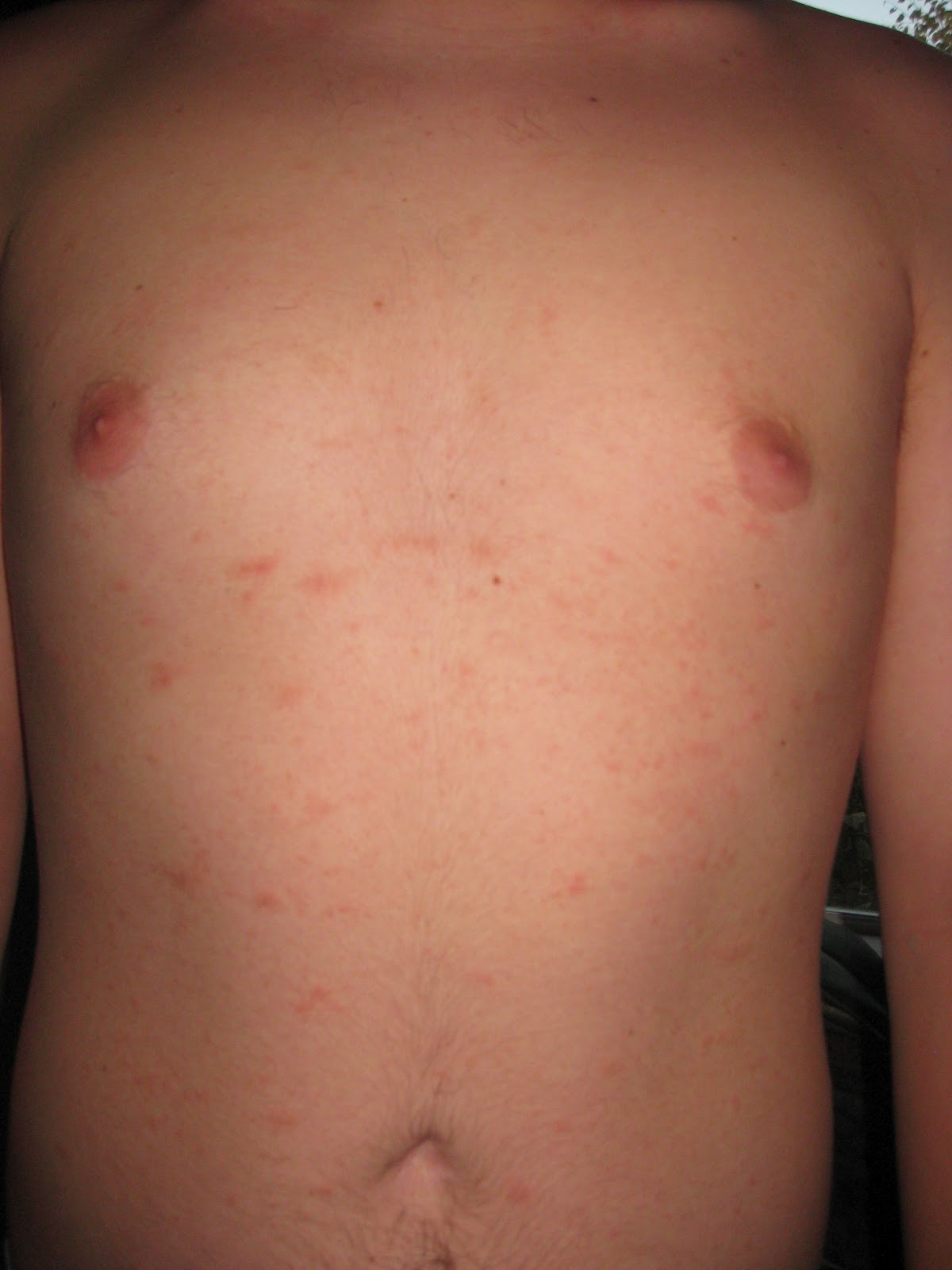 Chest rash - RightDiagnosis.com