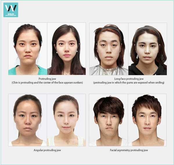 Protruding jaw surgery for jaw and facial outline improvements at once!