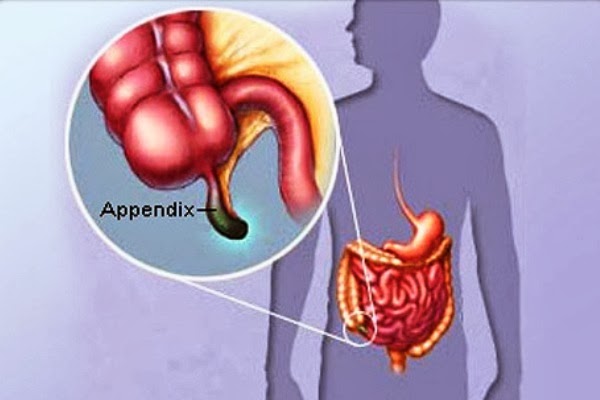 Gejala-gejala Awal Penyakit Usus Buntu (Apendisitis) | Medical Line