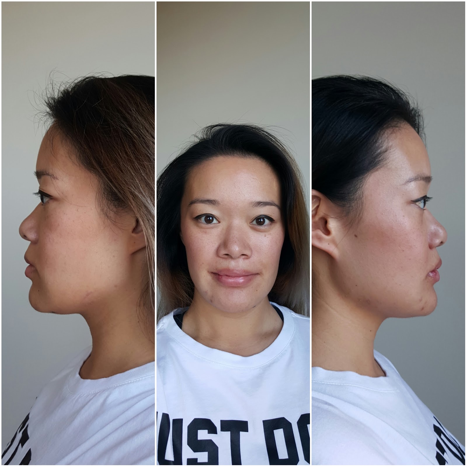 Tina's Double Jaw Surgery Day 22 3rd PostOp Appointment