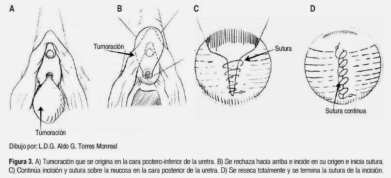 chist parauretral xp prostatita scleroza