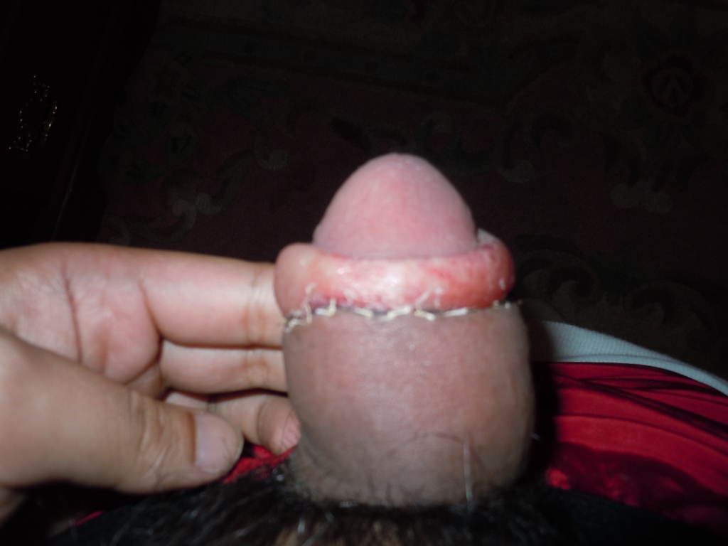 Swollen Penis After Circumcision 51