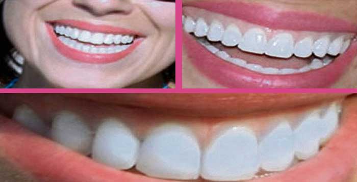 dis beyazlatma bleaching nedir ve