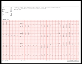 refractory atrial flutter icd 10 refractory atrial flutter icd 10