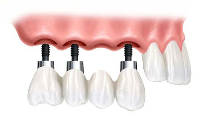  Quy trình làm cầu răng sứ cho răng bị mất