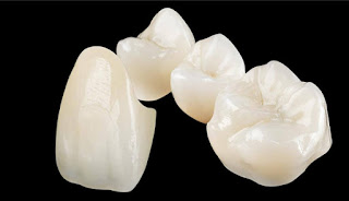Những điều cần biết về bọc sứ cho răng toàn hàm  Lam-rang-su-cercon-21