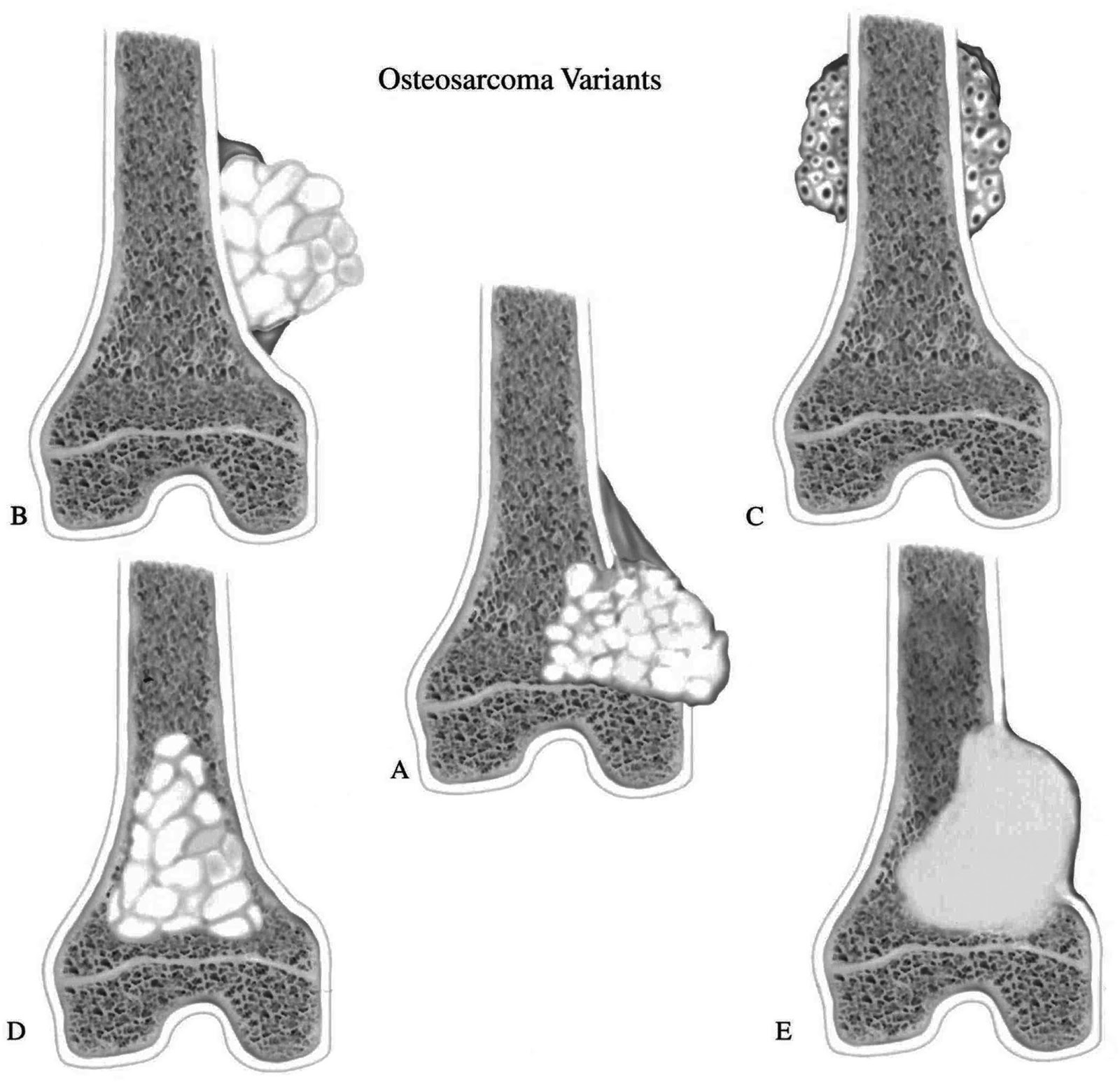 саркома юинга ( злокачественная опухоль. группирование по стадиям злокачественных опухолей. саркома юинга бедренной кости кт. рентгенодиагностика опухолей костей. рак кости стадии.
