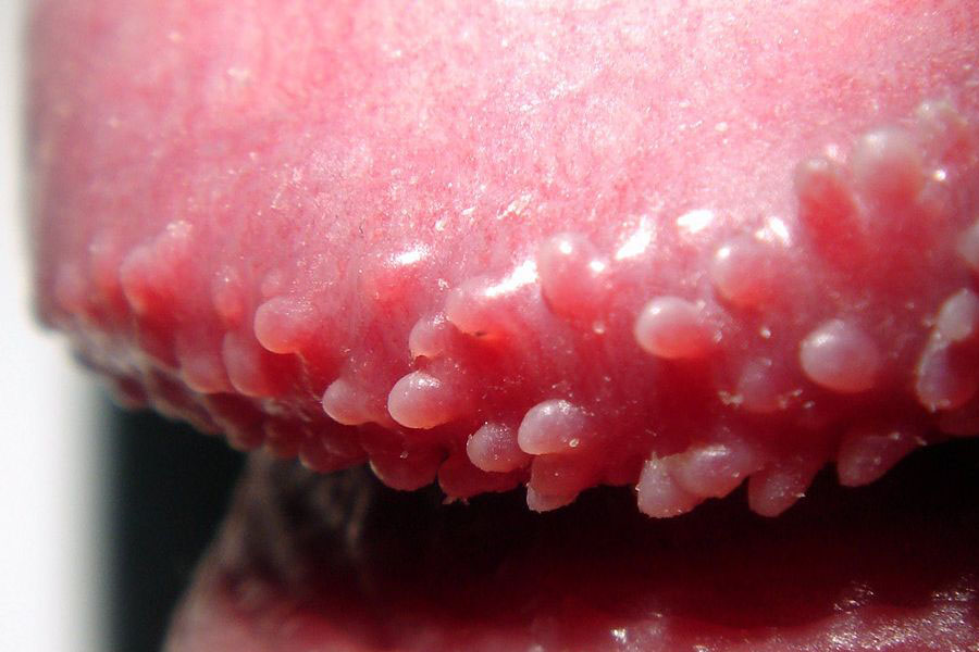 papulas-perladas-glande.jpg