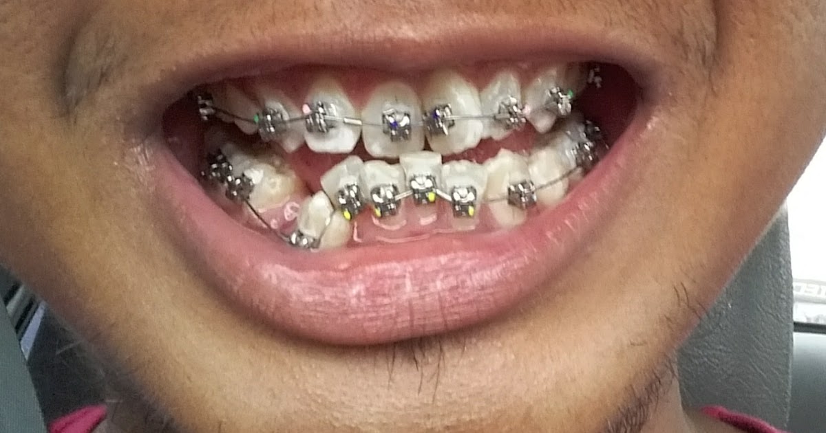 Progres Pemakaian Damon Braces Selepas 10 Bulan