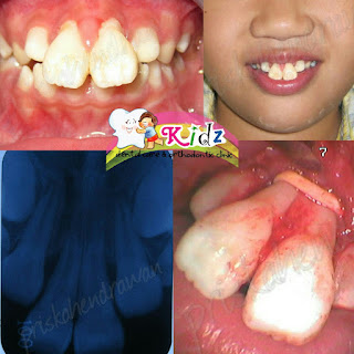 Bahaya Behel Gigi Online Shop - Kidz Dental Care