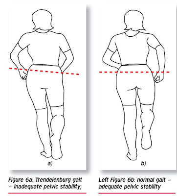 trendelenburg gait pelvic whilst likelihood