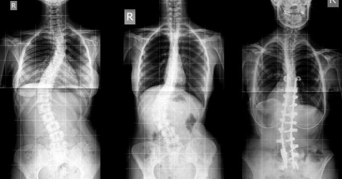 imaging-diagnostics-of-abnormalities-of-the-spine