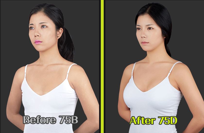 Breast Augmentation Surgery Premium Teardrop Implant Dual Chamber