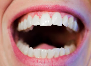 तनाव का दांतों पर बुरा असर और 95 प्रतिशत भारतीयों को मसूड़ों की बीमारी