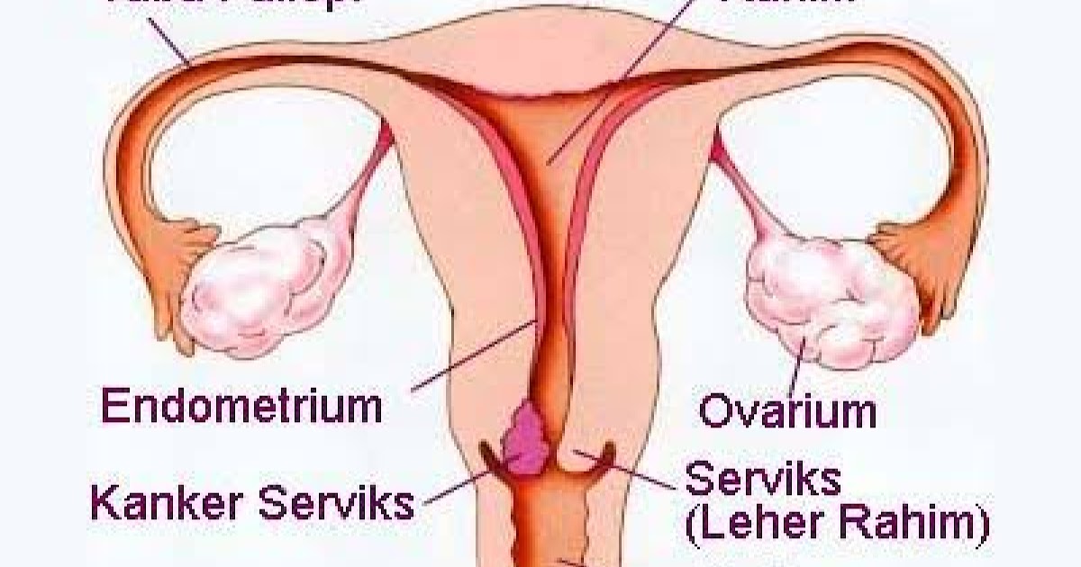 Obat Kanker Leher Rahim Tradisional Alami Paling Ampuh ...