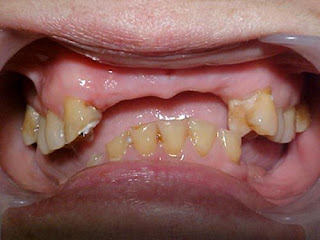 Mất răng và hậu quả khôn lường có thể xảy ra